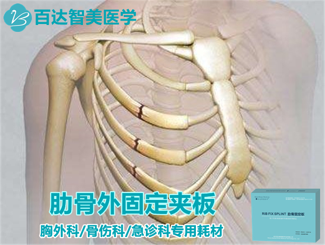 1790575668926669.jpg 肋骨固定夹板图.jpg